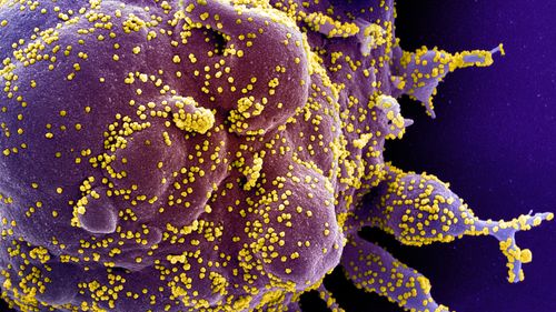 Electron Microscope image of an apoptotic cell (purple) heavily infected with SARS-COV-2 virus particles (yellow), isolated from a patient sample. Image