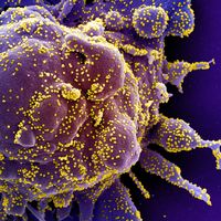 Electron Microscope image of an apoptotic cell (purple) heavily infected with SARS-COV-2 virus particles (yellow), isolated from a patient sample. Image