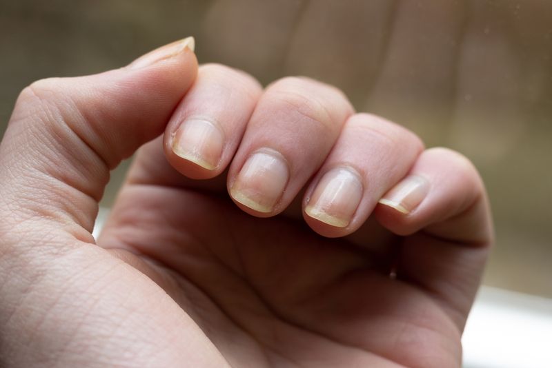 Bad nails and health 