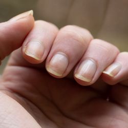 Bad nails and health 