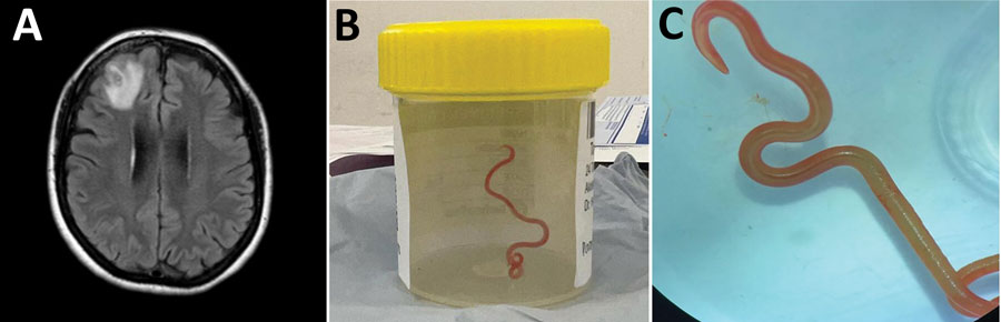 Left panel shows brain MRI image with lesion; middle panel shows worm in specimen jar after removal from brain; right panel shows the worm on a blue background.