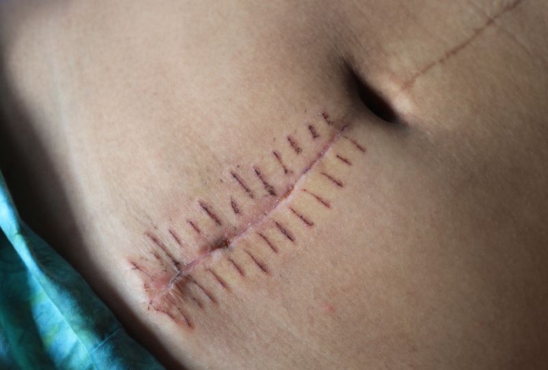 Image of a stomach with a scar on it c-section 