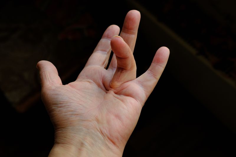 A hand shows off the characteristic bent finger position caused by Dupuytren’s contracture. 