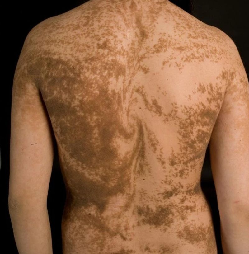 skin pigmentation caused by epidermal nevus