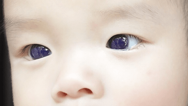 A child's eyes, glowing under UV light.