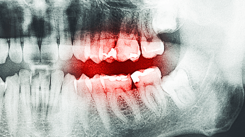 An x-ray of teeth, with decayed teeth highlighted in red.