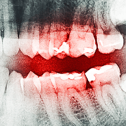 An x-ray of teeth, with decayed teeth highlighted in red.