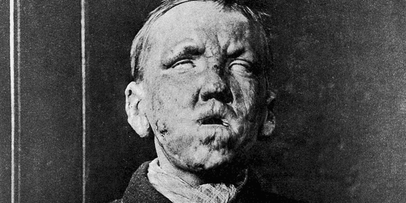 The face of a young man with leprosy taken from George Thin's 1891 book "Leprosy."