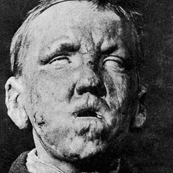 The face of a young man with leprosy taken from George Thin's 1891 book "Leprosy."