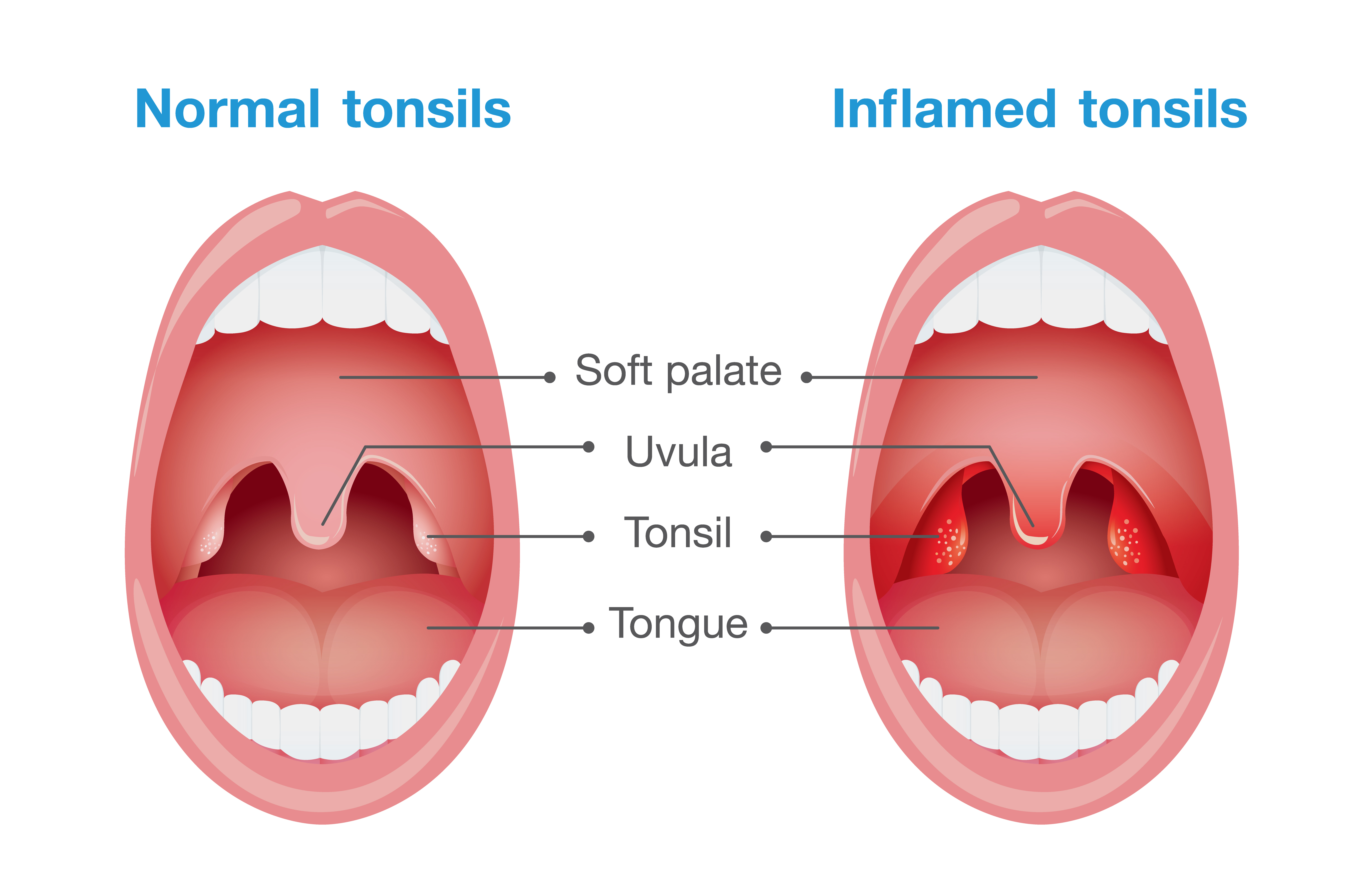 Diagram comparing normal tonsils (left) and inflamed tonsils (right)