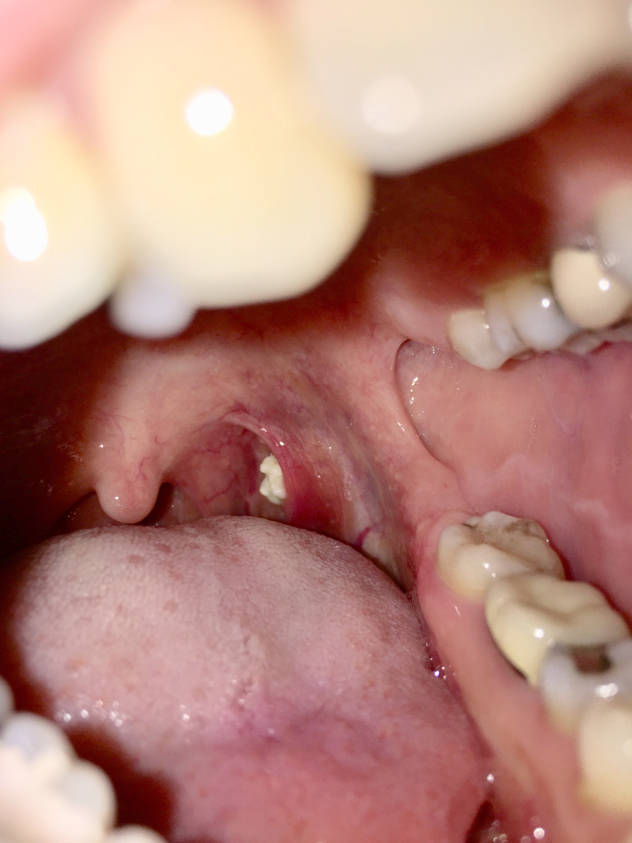 Photograph of the inside of a mouth, with a tonsil stone visible