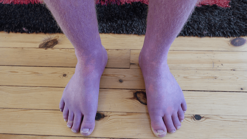A man's legs, which are a bluey-purple color.